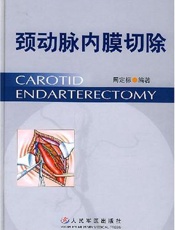 颈动脉内膜切除